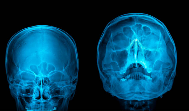 X-ray image of skull and paranasal sinuses (PNS).Everything is fine