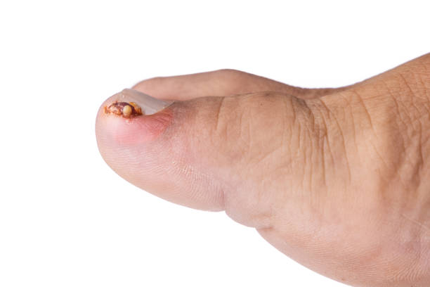 Toenail Pus Stock Photos, Pictures & Royalty-Free Images - iStock Toenail Pus Stock Photos, Pictures & Royalty-Free Images - iStock