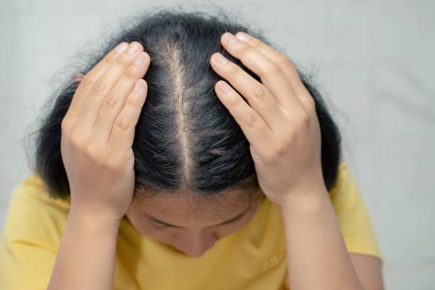 Woman hair loss from shampoo allergy. stock photo