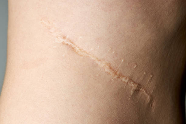 surgery scar after kidney pyelonephritis. after remove kidney operation. caucasian person close up over gray background surgery scar after kidney pyelonephritis. after remove kidney operation. caucasian person close up over gray background. scar stock pictures, royalty-free photos & images