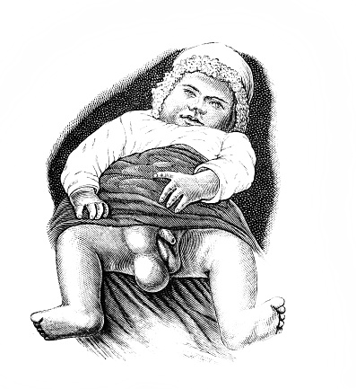 Swelling between a child's legs in the old book Chirurgie by Dr. Albert, Wien, 1882