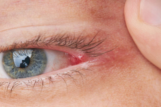 istock eyelid pimple macro close up. pimple near eye. hygiene problem 1267570668