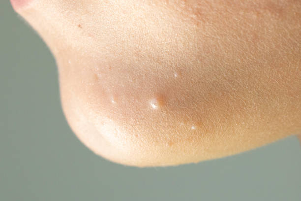 Close-up of Molluscum Contagiosum also called water wart. Viral formations in the chin on the skin of the child. Close-up of Molluscum Contagiosum also called water wart. Viral formations in the chin on the skin of the child. Maternal plaque is in the center and small later rash around. Health care. mollusca stock pictures, royalty-free photos & images