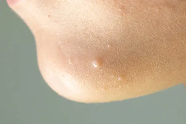 Photo of Close-up of Molluscum Contagiosum also called water wart. Viral formations in the chin on the skin of the child.