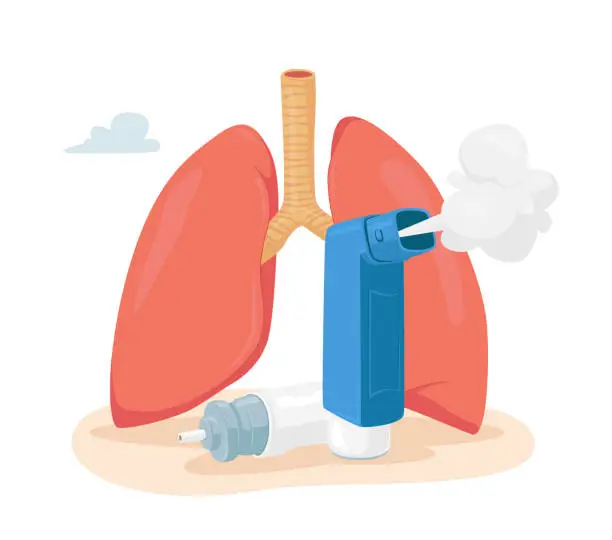 Vector illustration of Asthma Disease Concept. Human Lungs and Inhaler for Breathing. Chronic Sickness, Respiratory System Disease, Remedy