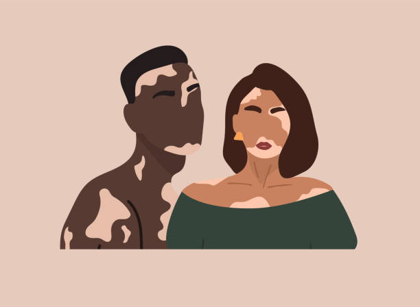 Abstract couple silhouette with vitiligo of different nationalities standing together. Vector concept to support people living with vitiligo and to build awareness about chronic skin disorder. Abstract couple silhouette with vitiligo of different nationalities standing together. Vector concept to support people living with vitiligo and to build awareness about chronic skin disorder vitiligo stock illustrations