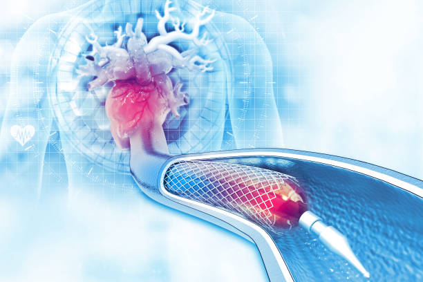 stent-angioplastie auf wissenschaftlichem hintergrund - angioplasty stock-fotos und bilder