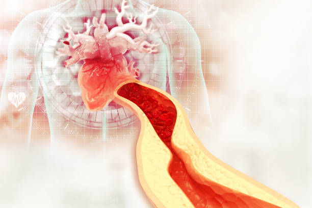 istock Cholesterol plaque in artery. 3d illustration 1268198100