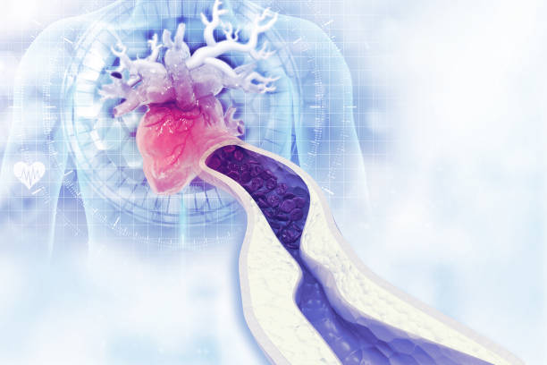 istock Cholesterol plaque in artery. 3d illustration 1268198282