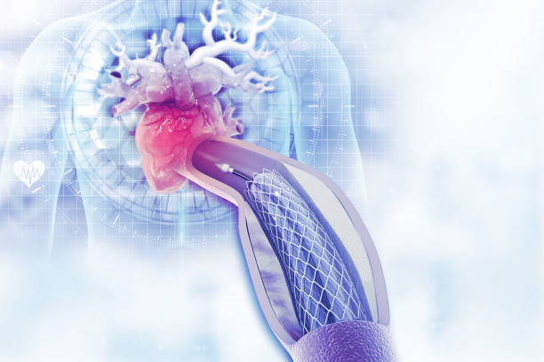 istock Stent angioplasty on scientific background 1268198399