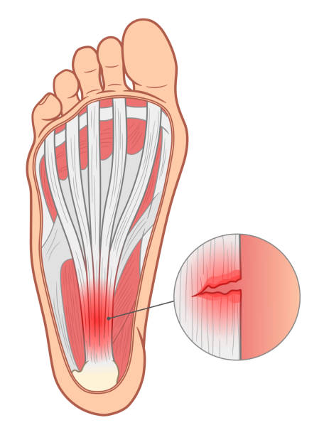 Plantar fasciitis illustration Plantar fasciitis medical vector illustration. fractured foot drawing stock illustrations