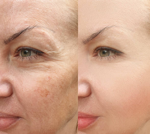 istock woman face wrinkles before and after treatment collage 1268297636