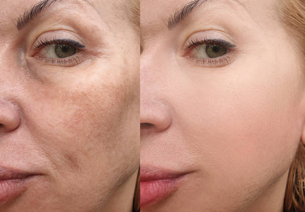 rides visage femme avant et après le collage de traitement - tighten skin photos et images de collection
