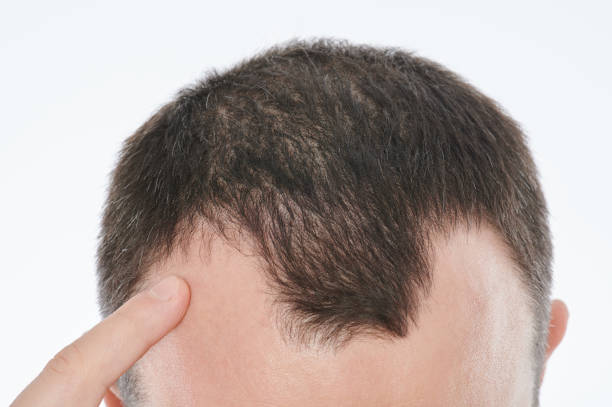 istock Man point to bold spot on head 1268455971
