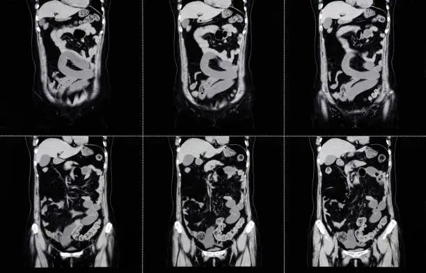 Photo of MRI Scan Human Abdominal Tomography