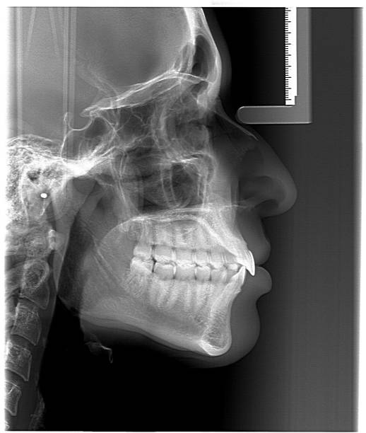 A lateral Cephalometric radiograph, X-Ray stock photo