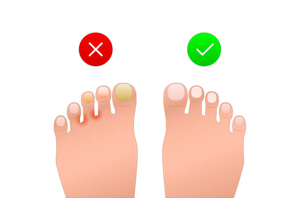 problem and healthy foot icon problem and healthy foot icon. representation patient’s feet with allergic, dermatitis, unguium. image of skin disease and rash. symbol for medical sites, apps. simple color sign isolated on white tinea stock illustrations