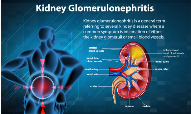 신장 구체성경화증의 의학 인포그래픽 - glomerulus stock illustrations