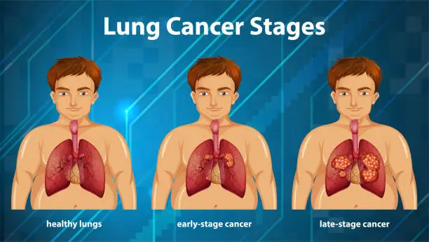 Vector illustration of Informative illustration of lung cancer stages