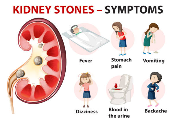 ilustraciones, imágenes clip art, dibujos animados e iconos de stock de síntomas de cálculos renales infografía estilo de dibujos animados - kidney stone