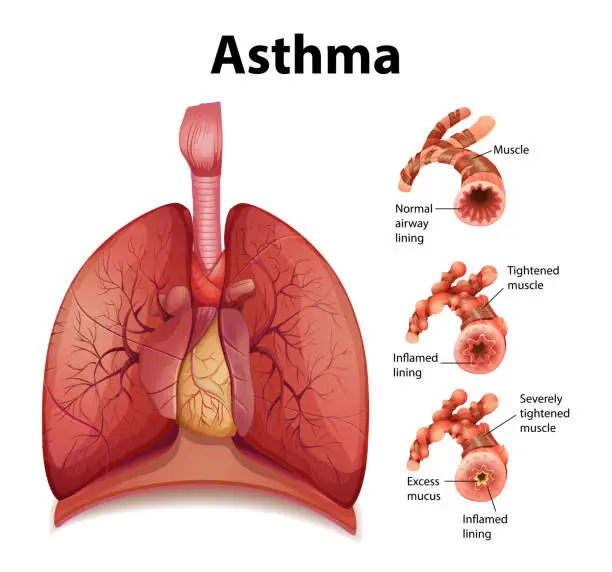 Vector illustration of Comparison of healthy lung and Asthmatic lung