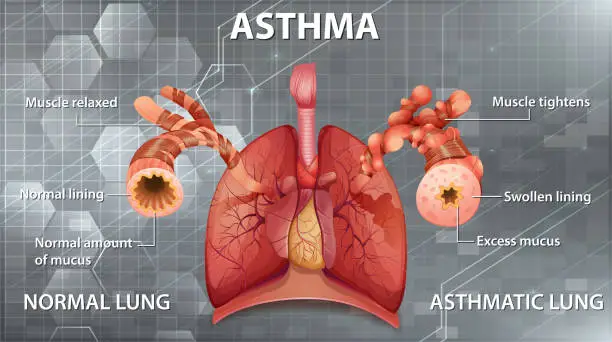 Vector illustration of Comparison of healthy lung and Asthmatic lung