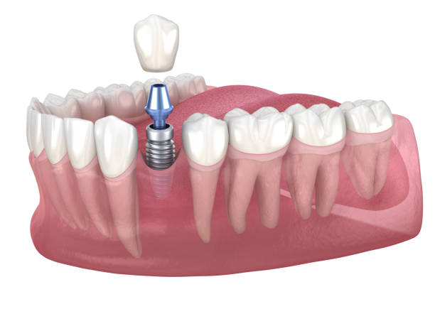 recuperación dental premolar con implante. ilustración 3d médicamente precisa del concepto de dientes y dentaduras postizas humanas - premolar fotografías e imágenes de stock