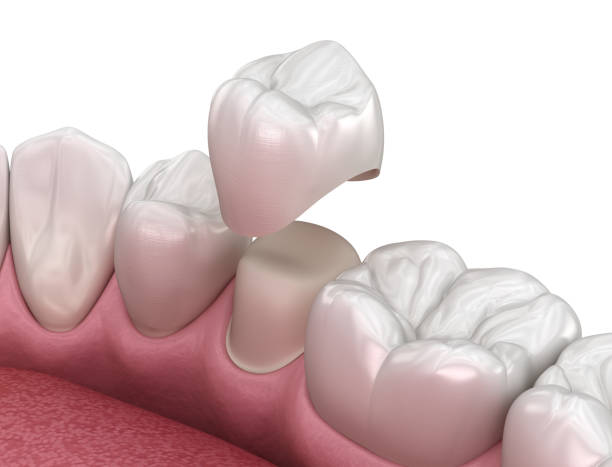 istock Preparated premolar tooth and dental crown placement. Medically accurate 3D illustration 1269231030