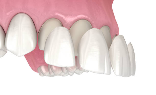 istock Veneer installation procedure over central incisor and lateral incisor. Medically accurate tooth 3D illustration 1269231036