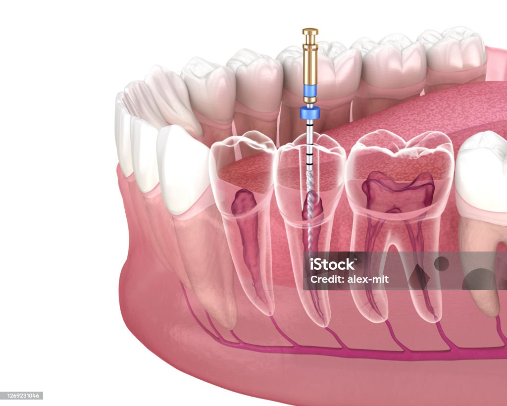 Endodontische WurzelkanalBehandlung. Medizinisch genaue Zahn 3D-Illustration. - Lizenzfrei Endodontie Stock-Foto