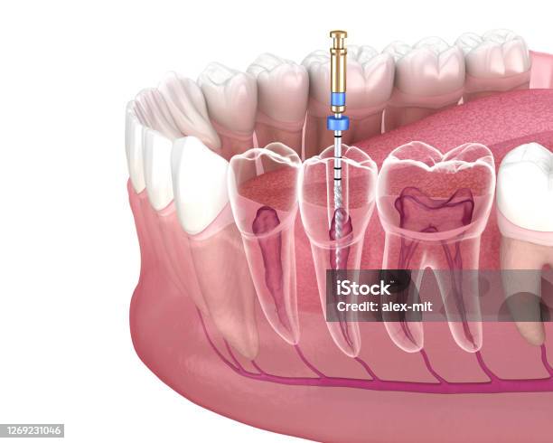 Endodontische Wurzelkanalbehandlung Medizinisch Genaue Zahn 3dillustration Stockfoto und mehr Bilder von Endodontie