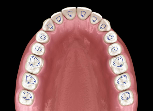 istock Root canal orifice locations plan of maxillary jaw. 3D illustration 1269231054