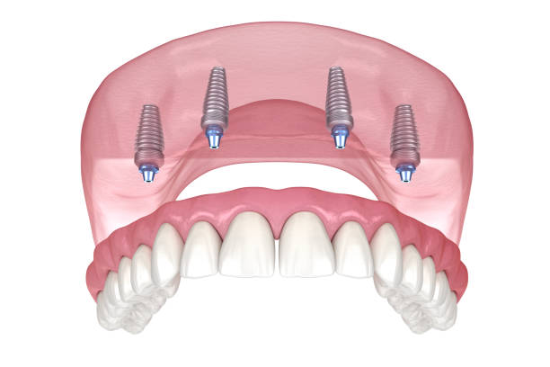 maxillary prosthesis with gum all on 4 system supported by implants. medically accurate 3d illustration of human teeth and dentures - implantat imagens e fotografias de stock