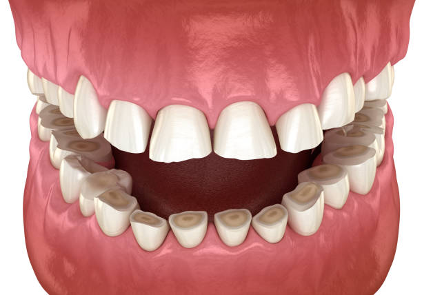 Dental attrition (Bruxism) resulting in loss of tooth tissue.  Medically accurate tooth 3D illustration Dental attrition (Bruxism) resulting in loss of tooth tissue.  Medically accurate tooth 3D illustration eroded stock pictures, royalty-free photos & images