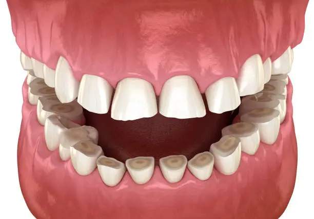 Dental attrition (Bruxism) resulting in loss of tooth tissue.  Medically accurate tooth 3D illustration