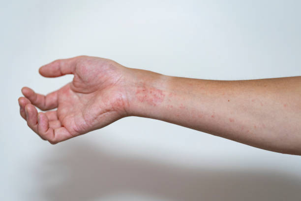 istock mild eczema in an adult man 1269235278
