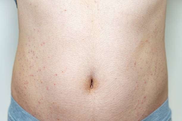 istock mild eczema in an adult man 1269235801
