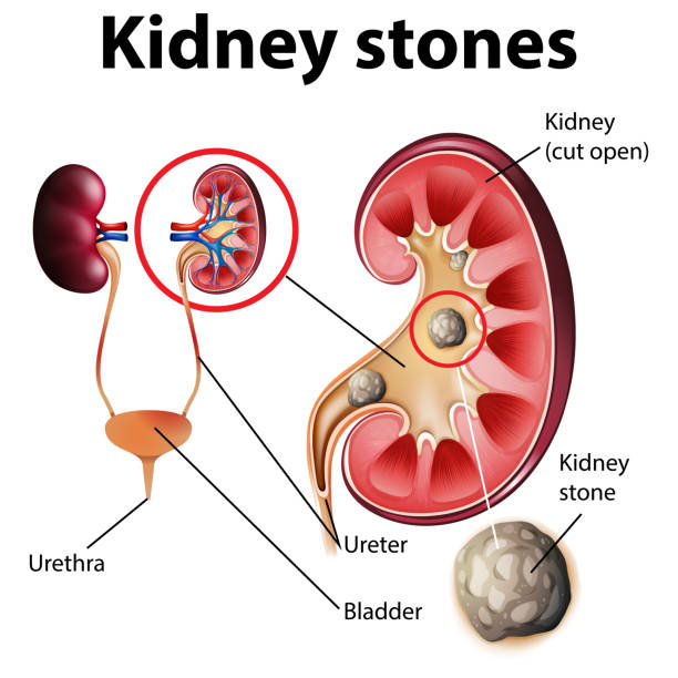 ilustraciones, imágenes clip art, dibujos animados e iconos de stock de ilustración informativa de cálculos renales - kidney stone