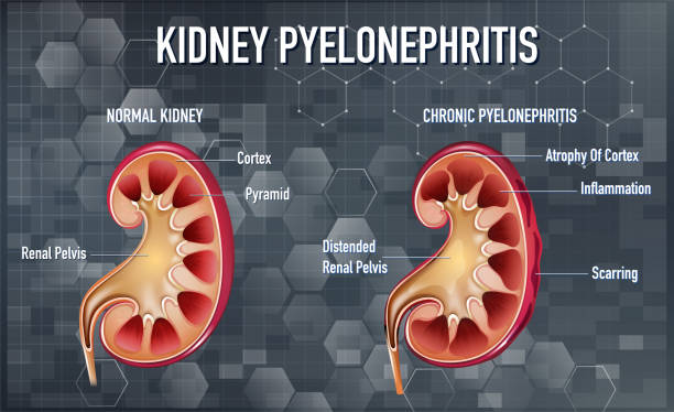 Informative illustration of Pyelonephritis Informative illustration of Pyelonephritis illustration pyelitis stock illustrations