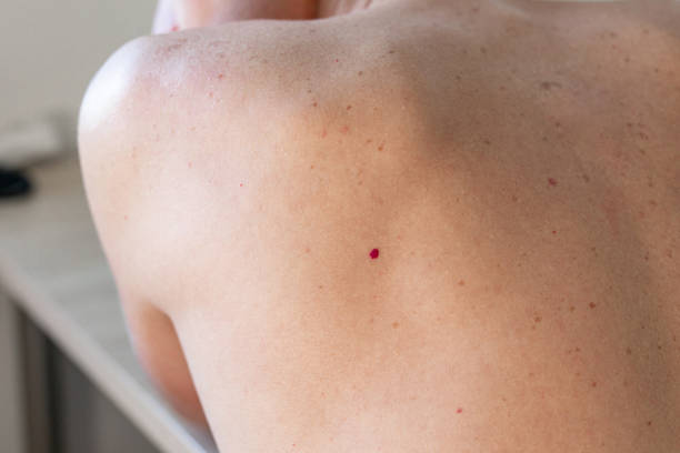 Close up photo of cherry angioma on human skin stock photo