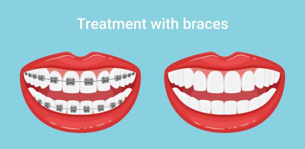 istock Teeth in the mouth with or without braces. During and after orthodontic treatment. The alignment of the teeth. Healthy lifestyle and dental care. White even teeth in a smile. Isolated flat vector. 1269245734