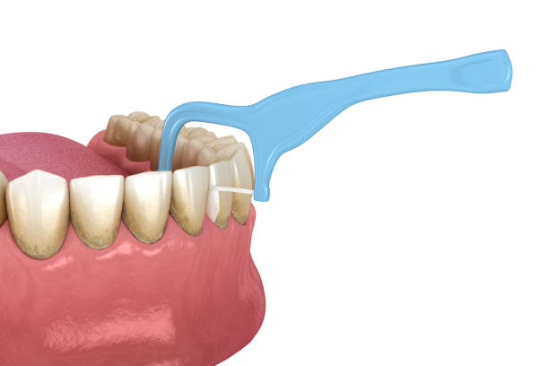 istock Oral hygiene: using toothpick dental floss to remove food stuck from teeth. Medically accurate dental 3D illustration 1269274732