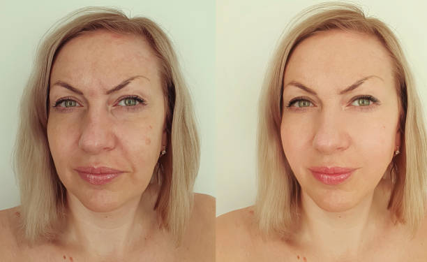 istock woman face wrinkles before and after treatment collage 1269366376