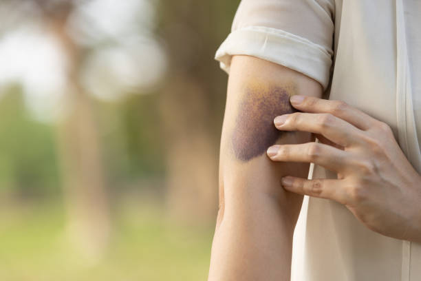 triste donna asiatica che mostra un livido al braccio, la donna ha lividi su tutto il corpo, causati dall'abuso di una famiglia o di suo marito aggredito violentemente, colpito da un duro, bashing causa lividi - violate foto e immagini stock