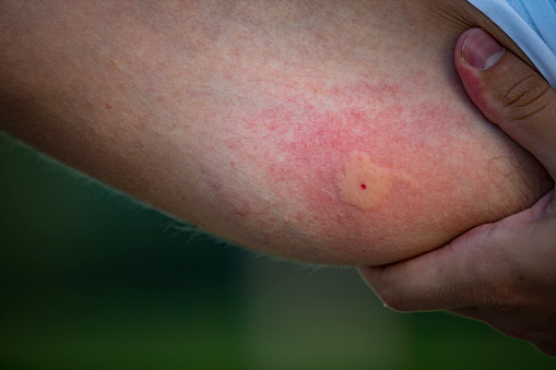 Close-up of Insect Bite on Arm of a Young Adult Man.