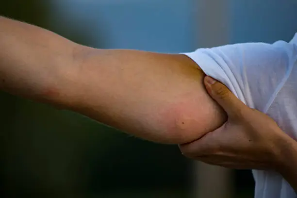 Close-up of an Insect Bite on Arm of a Young Man.