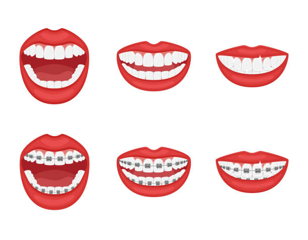 illustrations, cliparts, dessins animés et icônes de dents dans la bouche avec ou sans accolades. bouche ouverte et fermée avec lèvres rouges. dentisterie esthétique. traitement orthodontique pendant et après. l’alignement des dents. sain. vecteur isolé - mouth open illustrations