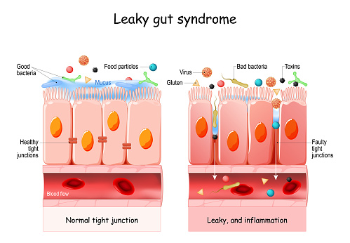 Leaky gut Syndrome. difference between Healthy cells, and inflamed intestinal cells. Comparison normal tissue of the gastrointestinal tract, and leaky gut.