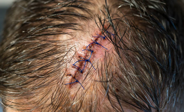 una herida cosida en la cabeza del hombre. vista de primer plano. - sewing stitches thread surgery fotografías e imágenes de stock