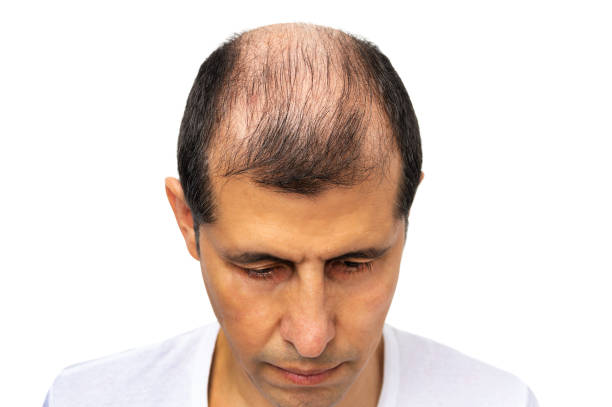 istock Hair loss concept 1269844258